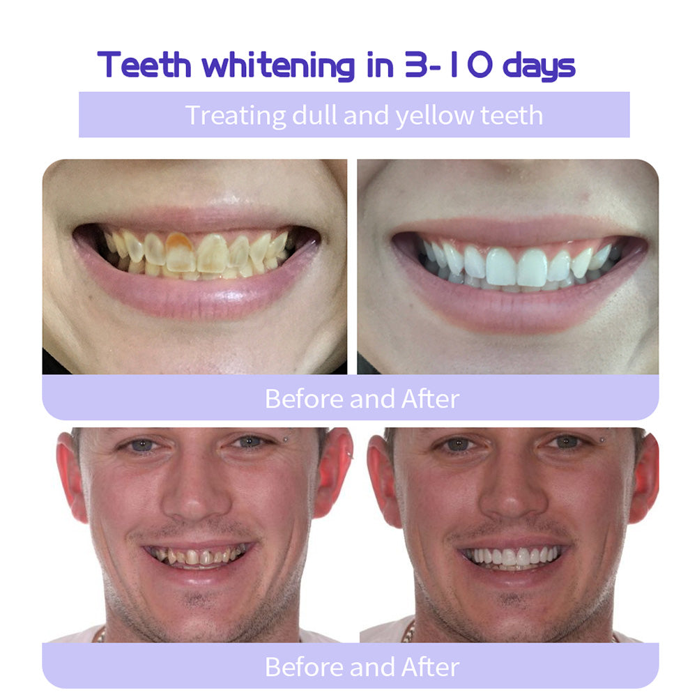 ✨🦷BBOJI™ TeethRestoration Mineral Powder💋(ADA recommended)